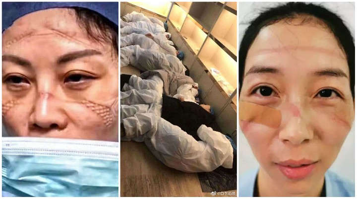 “Oni su anđeli, oni su heroji” – Medicinske sestre dijele fotografije kako izgleda njihovo lice nakon bezbroj sati borbe protiv koronavirusa